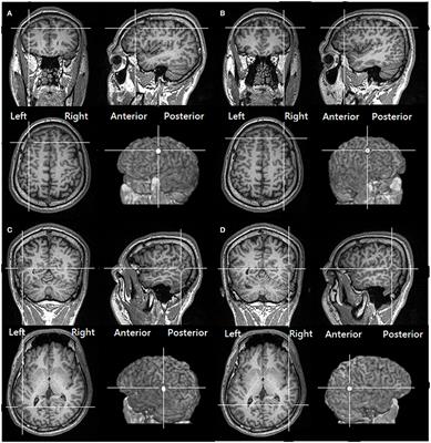 The Impact of Single Session Intermittent Theta-Burst Stimulation over the Dorsolateral Prefrontal Cortex and Posterior Superior Temporal Sulcus on Adults with Autism Spectrum Disorder